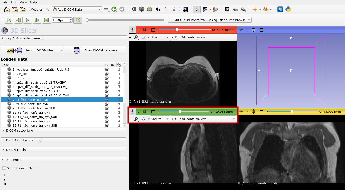 MRI image in 3D Slicer